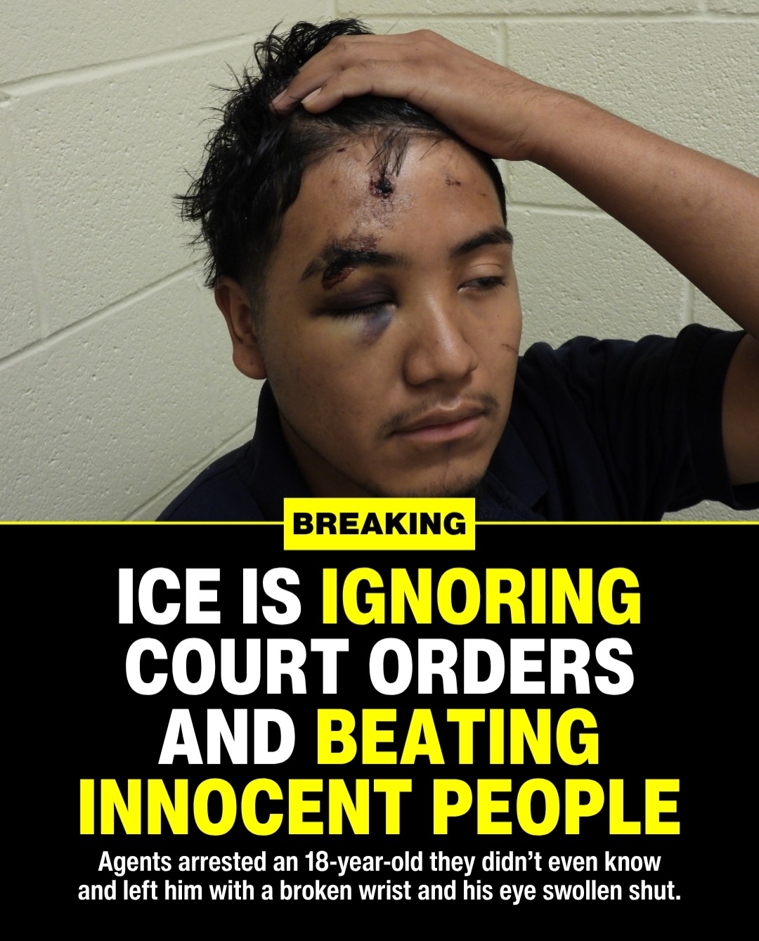 18-year-old beaten by ICE agents, left with broken wrist and swollen eye